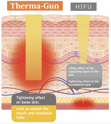 当サロンのサーマリフトの特徴
