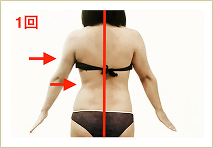 HIFU（BODY）
